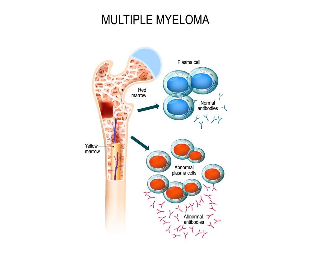 Is multiple myeloma cancer curable